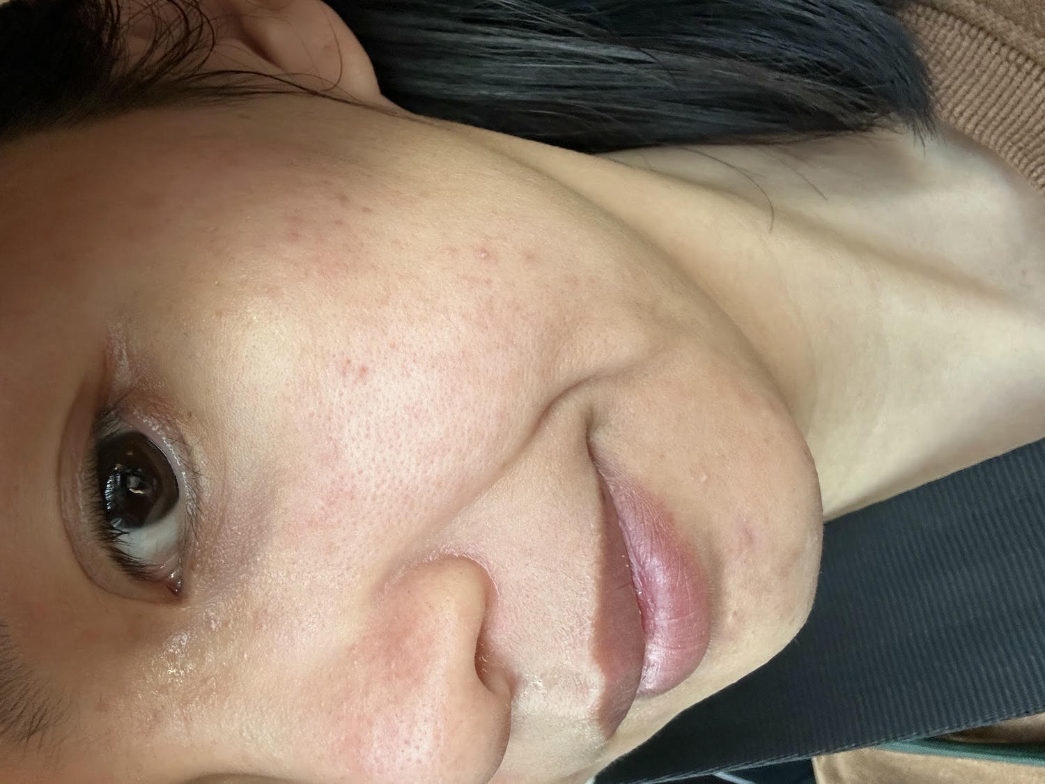 台中佳思優醫美診所。第一次的皮秒雷射經驗分享。恢復期保養需要注意的地方。 - 第20張圖