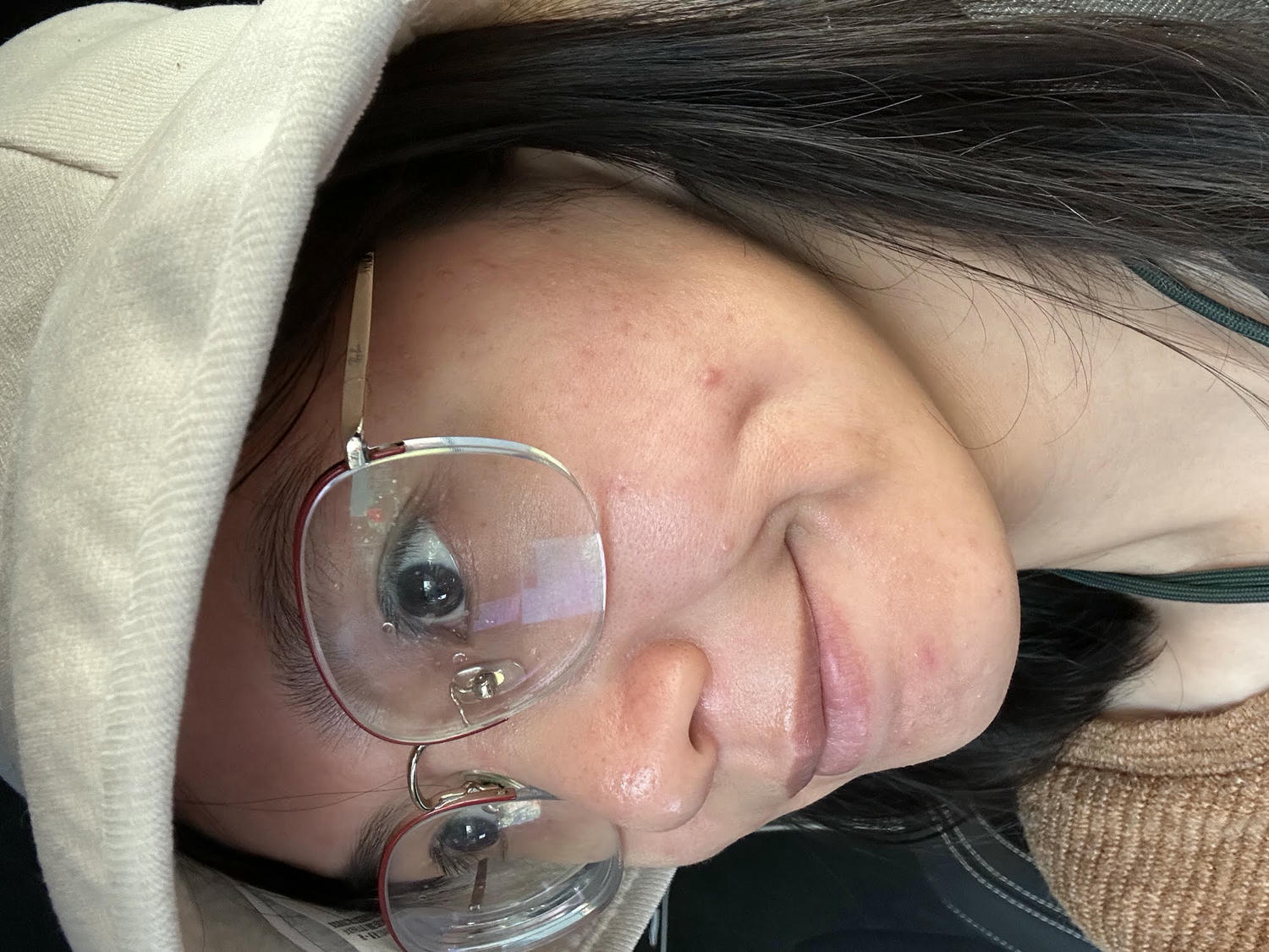 台中佳思優醫美診所。第一次的皮秒雷射經驗分享。恢復期保養需要注意的地方。 - 第19張圖